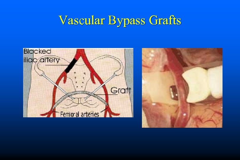 Vascular Bypass Grafts 