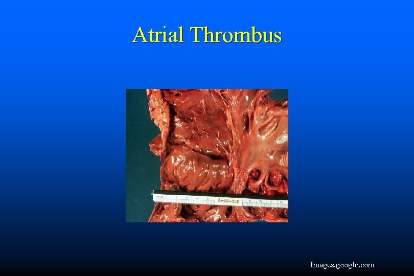 Atrial Thrombus Images. google. com 