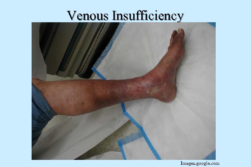 Venous Insufficiency Images. google. com 