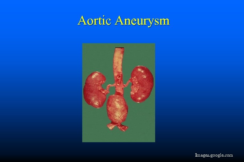 Aortic Aneurysm Images. google. com 