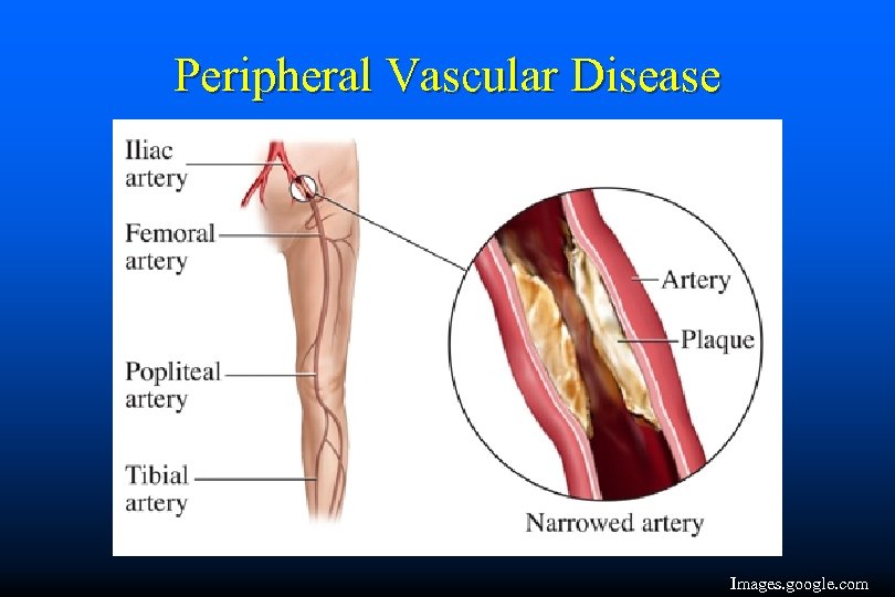 Peripheral Vascular Disease Images. google. com 