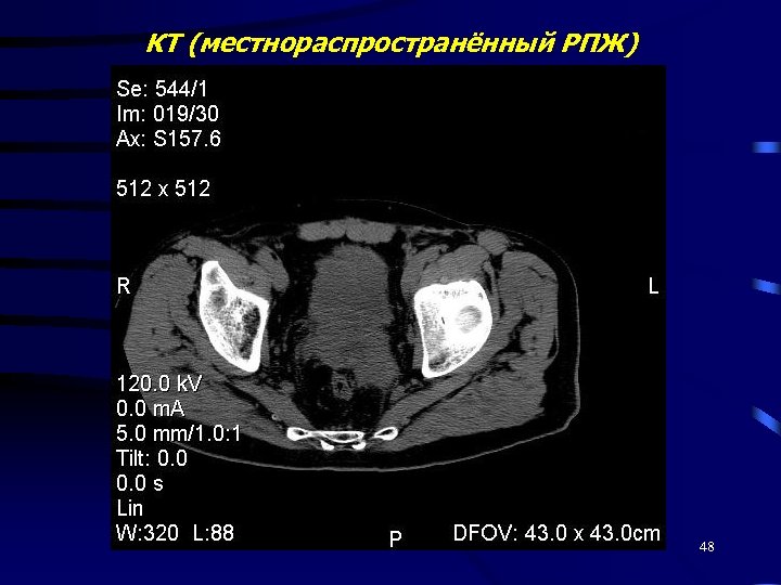 КТ (местнораспространённый РПЖ) 48 