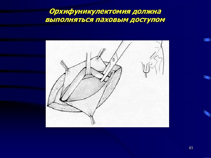 Орхифуникулектомия должна выполняться паховым доступом 63 