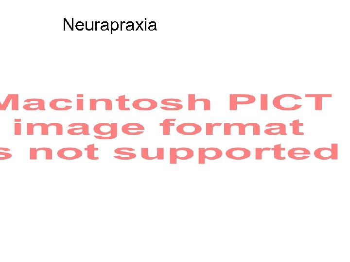 Neurapraxia 