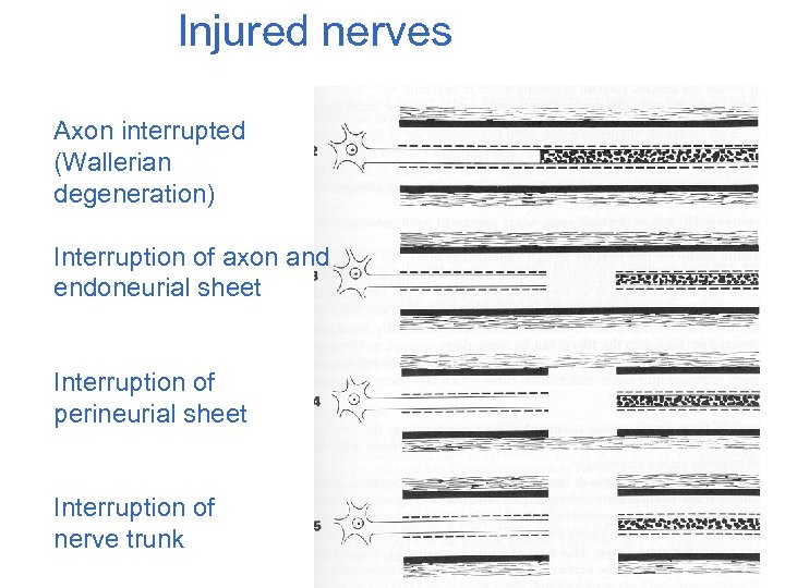 Injured nerves Axon interrupted (Wallerian degeneration) Interruption of axon and endoneurial sheet Interruption of