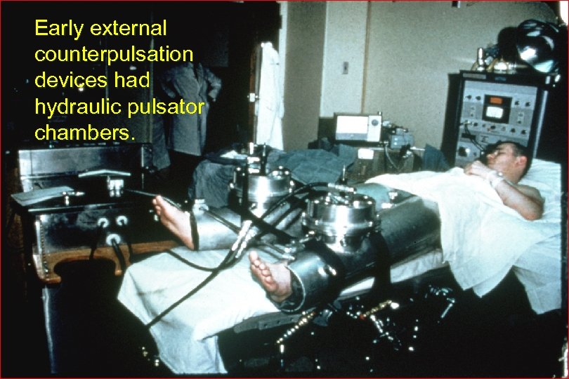 Early external counterpulsation devices had hydraulic pulsator chambers. 