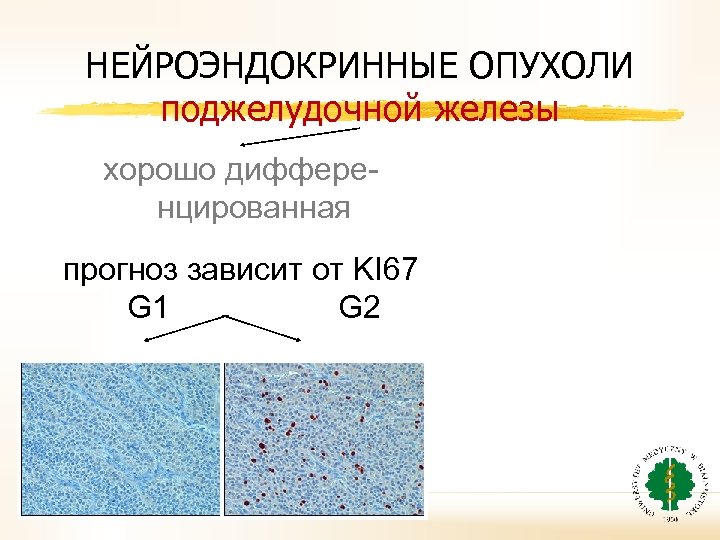 НЕЙРОЭНДОКРИННЫЕ ОПУХОЛИ поджелудочной железы хорошо дифференцированная прогноз зависит от KI 67 G 1 G