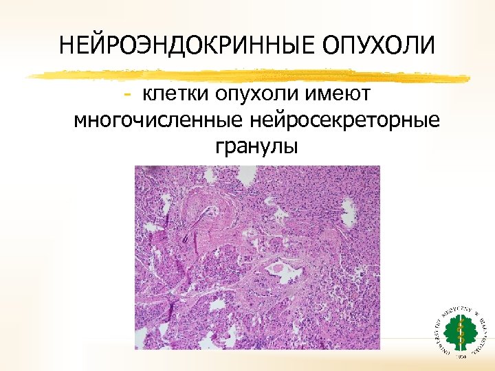 НЕЙРОЭНДОКРИННЫЕ ОПУХОЛИ - клетки опухоли имеют многочисленные нейросекреторные гранулы 