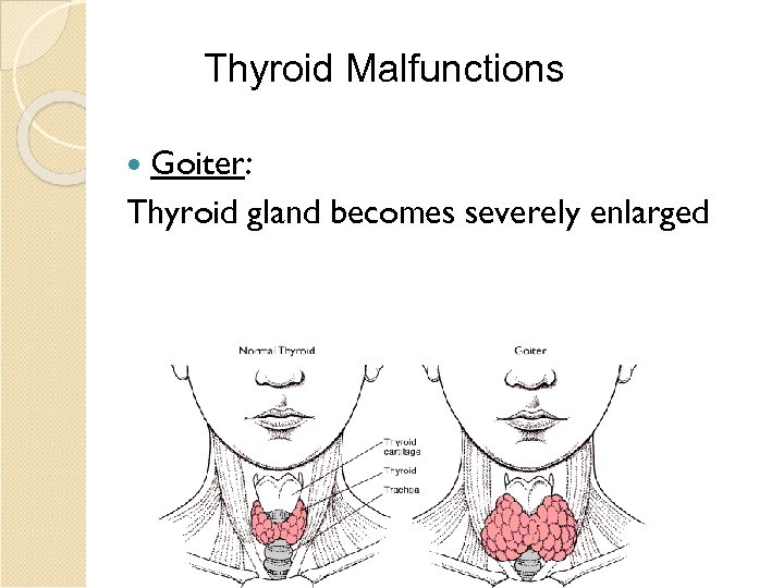 Thyroid Malfunctions Goiter: Thyroid gland becomes severely enlarged 