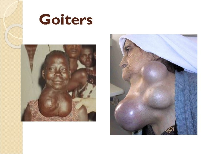 Goiters 