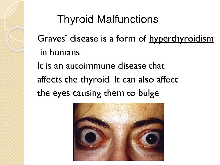 Thyroid Malfunctions Graves’ disease is a form of hyperthyroidism in humans It is an