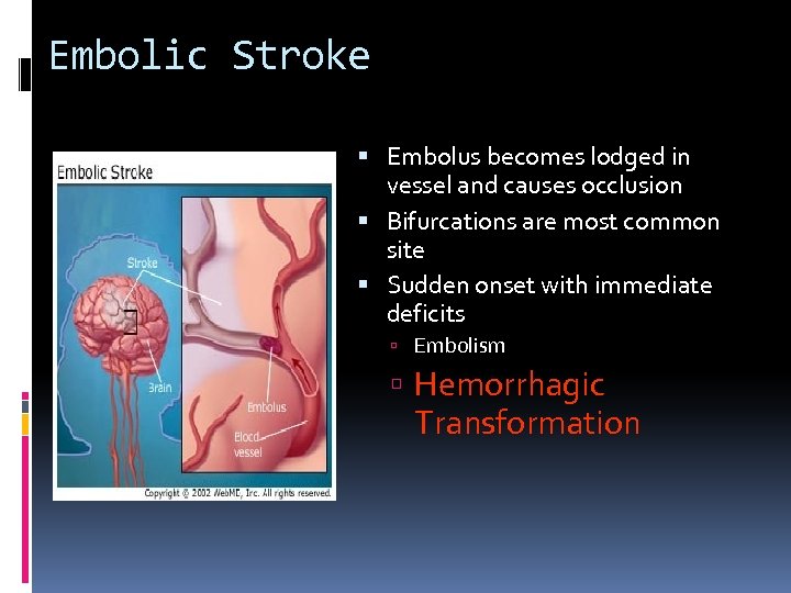 Embolic Stroke Embolus becomes lodged in vessel and causes occlusion Bifurcations are most common