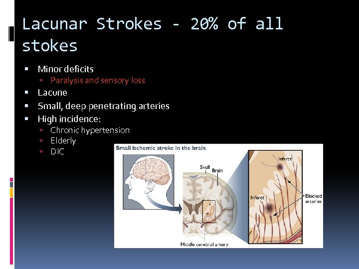 Lacunar Strokes - 20% of all stokes Minor deficits Paralysis and sensory loss Lacune
