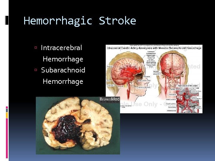 Hemorrhagic Stroke Intracerebral Hemorrhage Subarachnoid Hemorrhage 