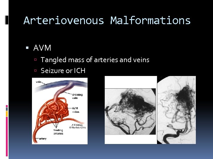 Arteriovenous Malformations AVM Tangled mass of arteries and veins Seizure or ICH 