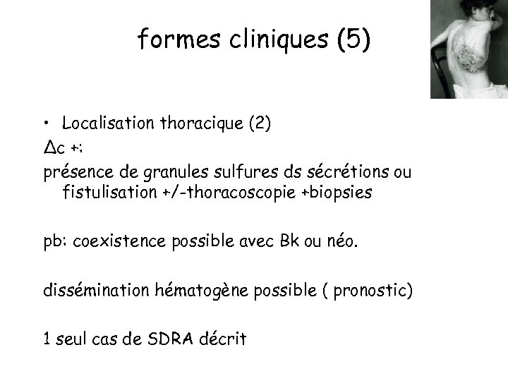 formes cliniques (5) • Localisation thoracique (2) Δc +: présence de granules sulfures ds