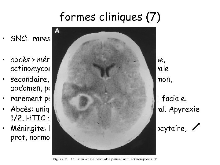 formes cliniques (7) • SNC: rares • abcès > méningite > m-encéphalite > empyème,