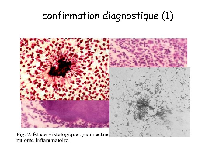 confirmation diagnostique (1) • Certitude: repose sur l’ isolement d’ Actinomyces sp. Ds les