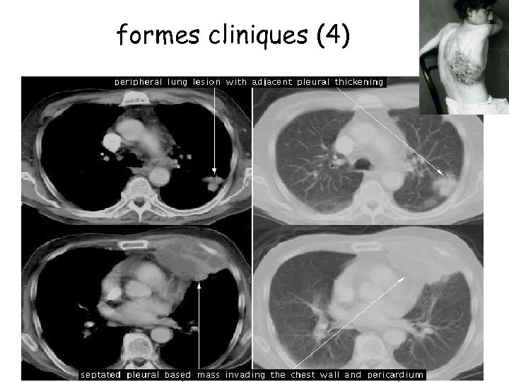 formes cliniques (4) • Localisation thoracique: 15 % • poumons, plèvre, médiastin et paroi.