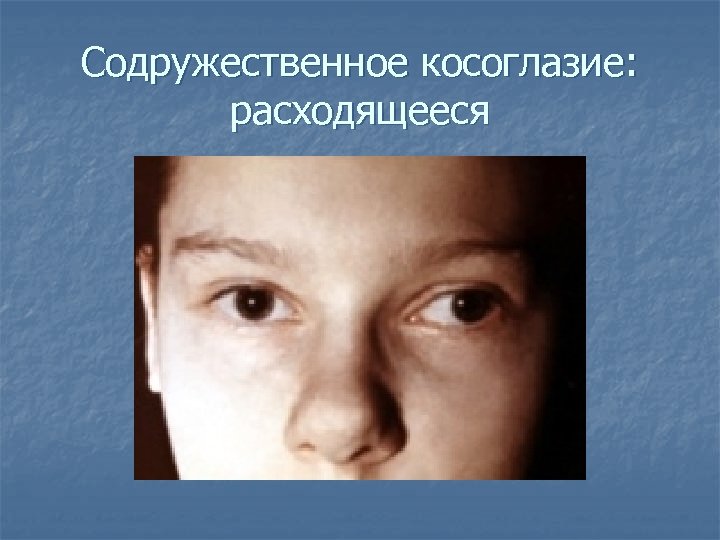 Содружественное косоглазие: расходящееся 