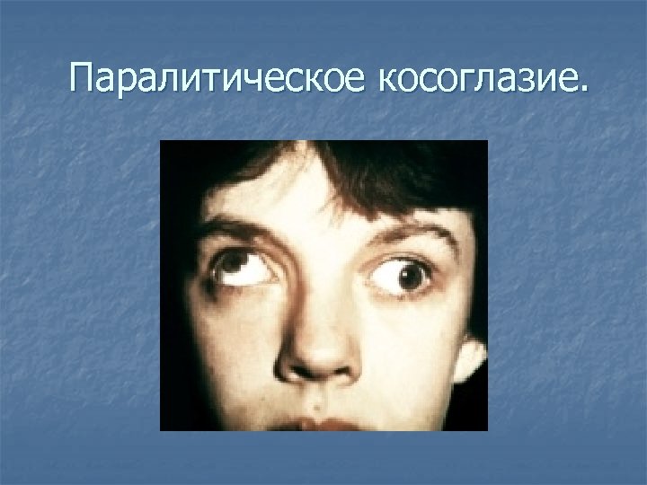 Паралитическое косоглазие. 