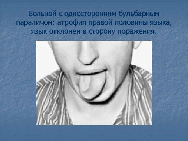 Больной с односторонним бульбарным параличом: атрофия правой половины языка, язык отклонен в сторону поражения.