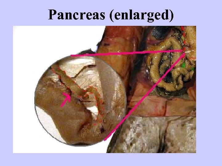 Pancreas (enlarged) 