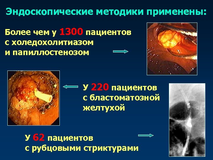 Эндоскопические методики применены: Более чем у 1300 пациентов с холедохолитиазом и папиллостенозом У 220