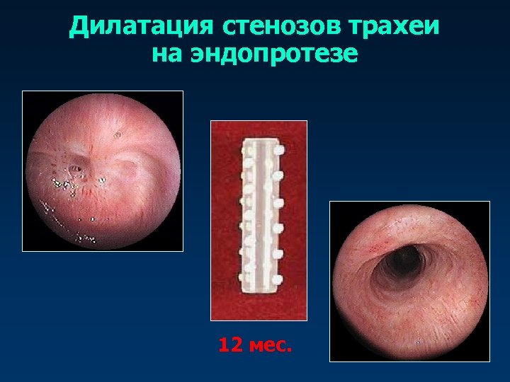 Дилатация стенозов трахеи на эндопротезе 12 мес. 