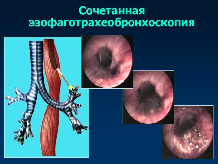 Сочетанная эзофаготрахеобронхоскопия 