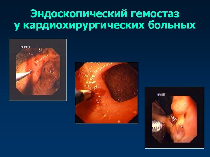Эндоскопический гемостаз у кардиохирургических больных 