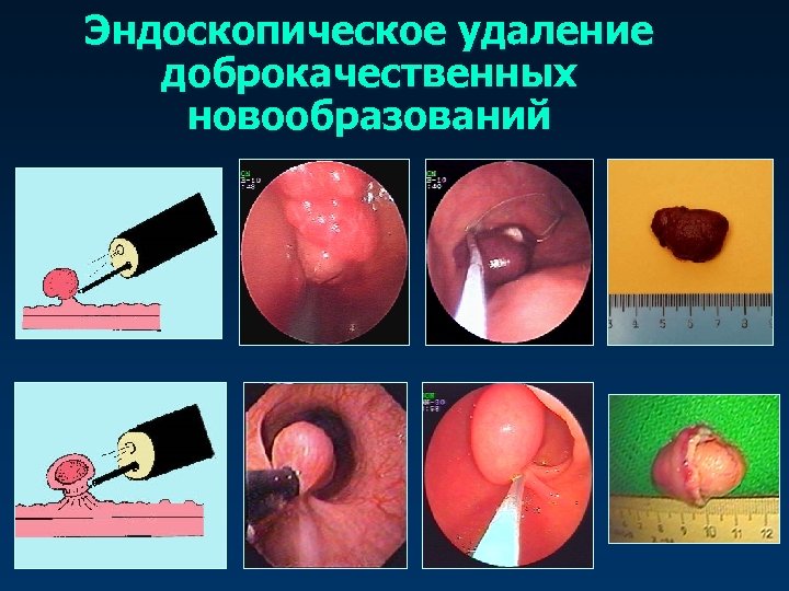 Эндоскопическое удаление доброкачественных новообразований 