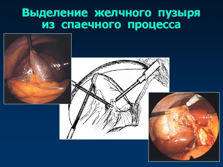 Выделение желчного пузыря из спаечного процесса 