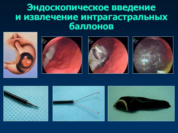 Эндоскопическое введение и извлечение интрагастральных баллонов 