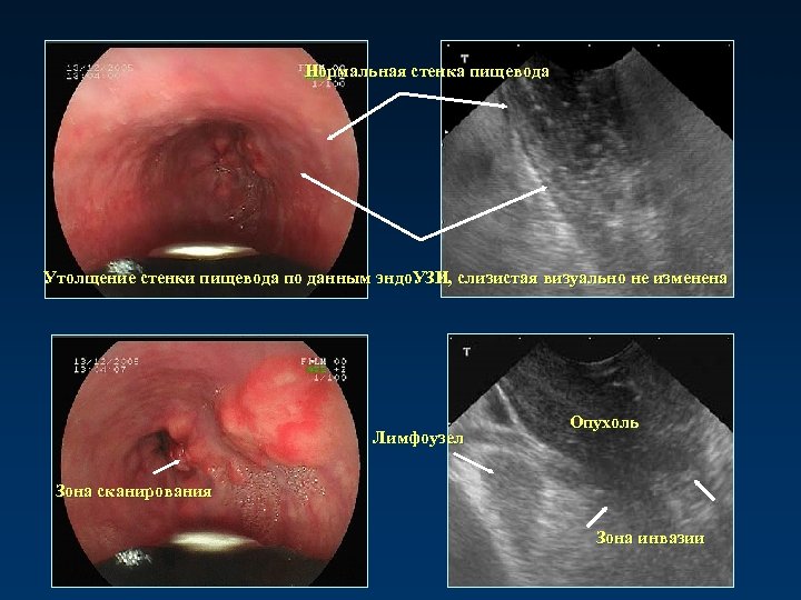 Нормальная стенка пищевода Утолщение стенки пищевода по данным эндо. УЗИ, слизистая визуально не изменена