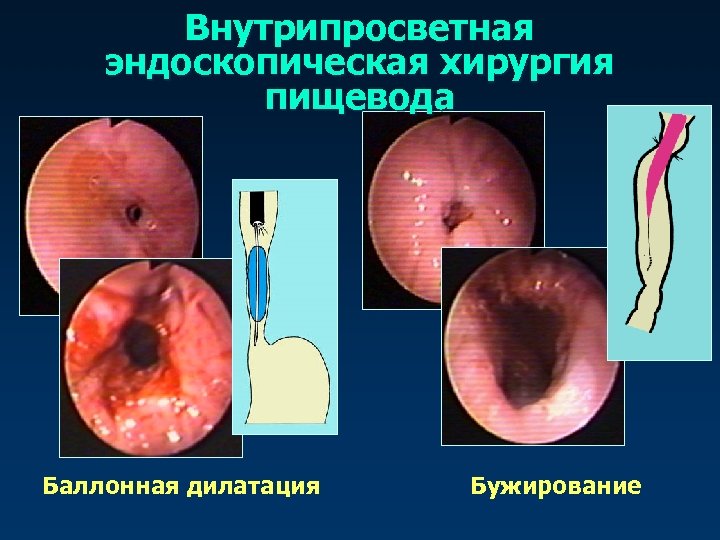 Внутрипросветная эндоскопическая хирургия пищевода Баллонная дилатация Бужирование 