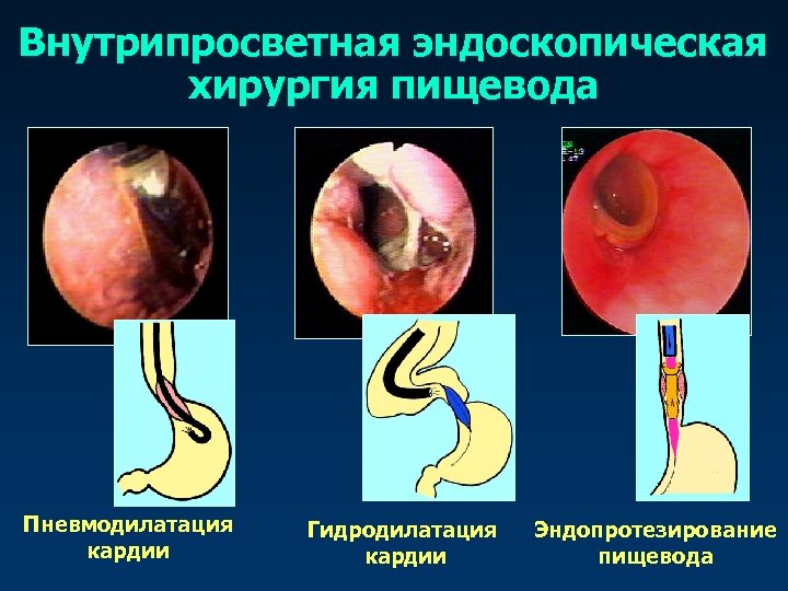 Внутрипросветная эндоскопическая хирургия пищевода Пневмодилатация кардии Гидродилатация кардии Эндопротезирование пищевода 