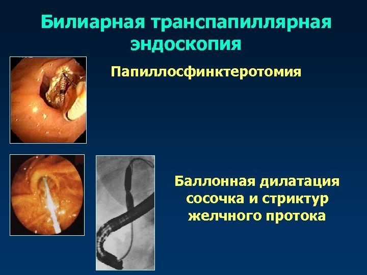 Билиарная транспапиллярная эндоскопия Папиллосфинктеротомия Баллонная дилатация сосочка и стриктур желчного протока 