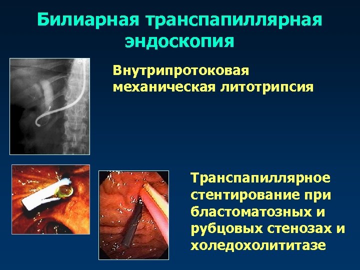 Билиарная транспапиллярная эндоскопия Внутрипротоковая механическая литотрипсия Транспапиллярное стентирование при бластоматозных и рубцовых стенозах и