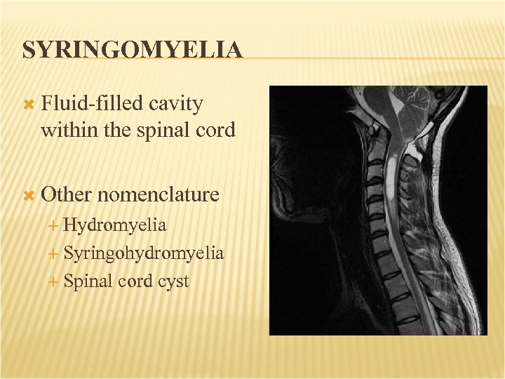 SYRINGOMYELIA Fluid-filled cavity within the spinal cord Other nomenclature Hydromyelia Syringohydromyelia Spinal cord cyst