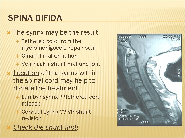 SPINA BIFIDA The syrinx may be the result Tethered cord from the myelomenigocele repair