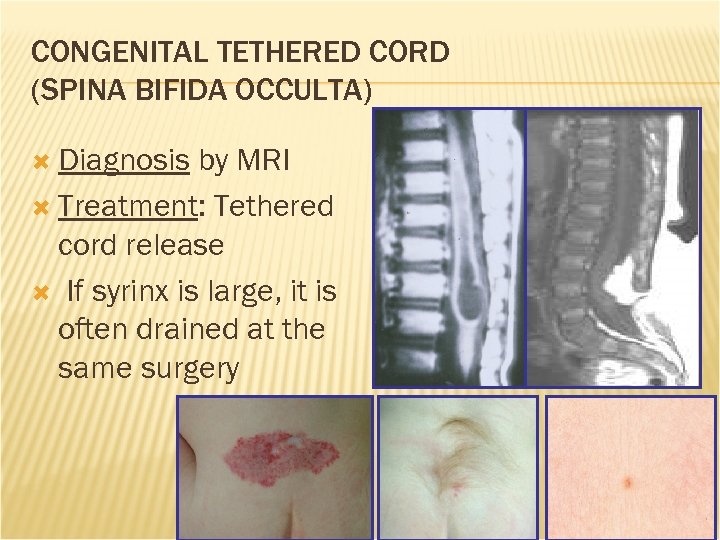 CONGENITAL TETHERED CORD (SPINA BIFIDA OCCULTA) Diagnosis by MRI Treatment: Tethered cord release If