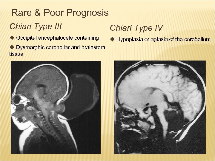 Rare & Poor Prognosis Chiari Type III Chiari Type IV u Occipital encephalocele containing