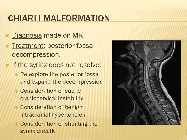 CHIARI I MALFORMATION Diagnosis made on MRI Treatment: posterior fossa decompression. If the syrinx