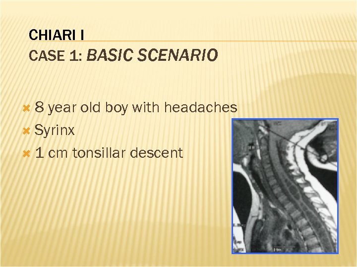 CHIARI I CASE 1: BASIC SCENARIO 8 year old boy with headaches Syrinx 1
