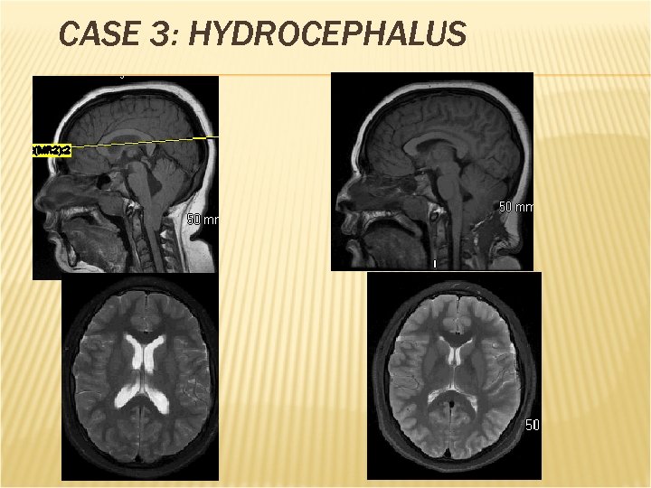 CASE 3: HYDROCEPHALUS 
