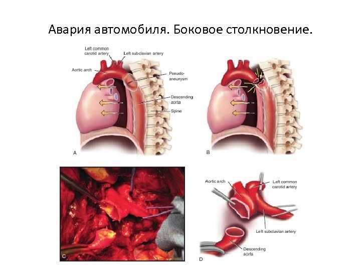 Авария автомобиля. Боковое столкновение. 