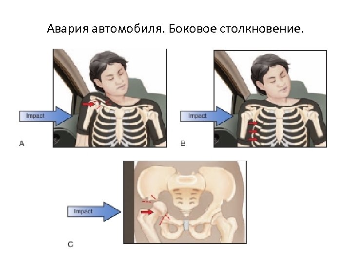 Авария автомобиля. Боковое столкновение. 