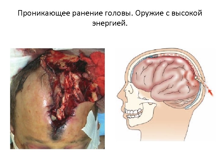 Проникающее ранение головы. Оружие с высокой энергией. 