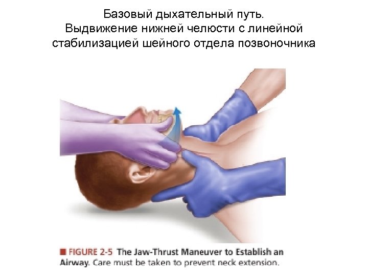 Базовый дыхательный путь. Выдвижение нижней челюсти с линейной стабилизацией шейного отдела позвоночника 